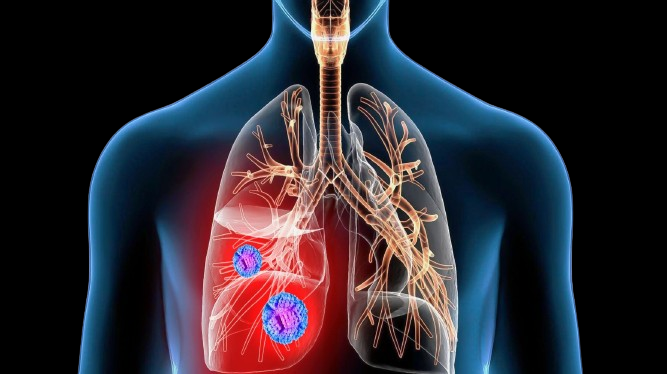 5 major facts of Lungs cancer